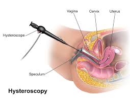 Hystroscopic surgery